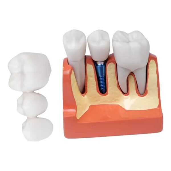 Modelo De Coroa Dentária Para Análise De Implante Removível