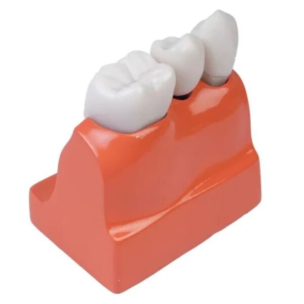 Modelo De Coroa Dentária Para Análise De Implante Removível - Imagem 2