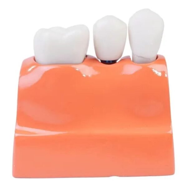 Modelo De Coroa Dentária Para Análise De Implante Removível - Imagem 3