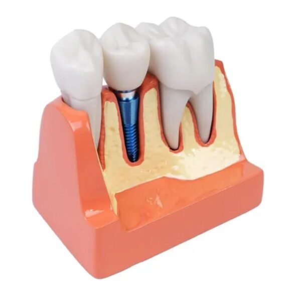 Modelo De Coroa Dentária Para Análise De Implante Removível - Imagem 4
