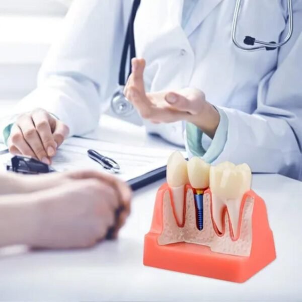 Modelo De Coroa Dentária Para Análise De Implante Removível - Imagem 5