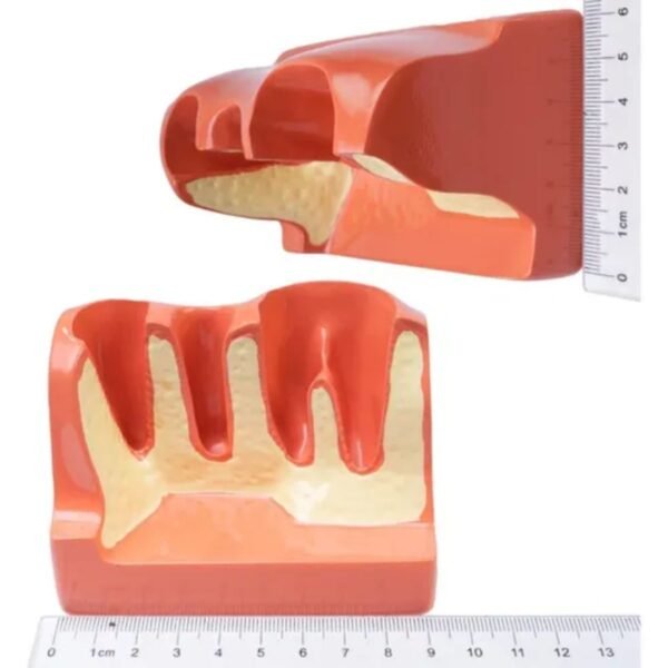 Modelo De Coroa Dentária Para Análise De Implante Removível - Imagem 6